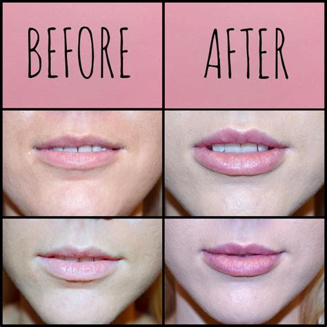 Lip fillers don’t have to be over done. This patient wanted a more ...