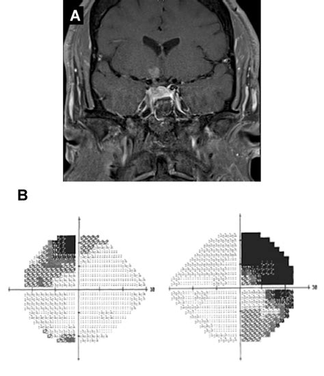 Vision Loss Due to Herniation of the Optic Chiasm | Duke Health ...