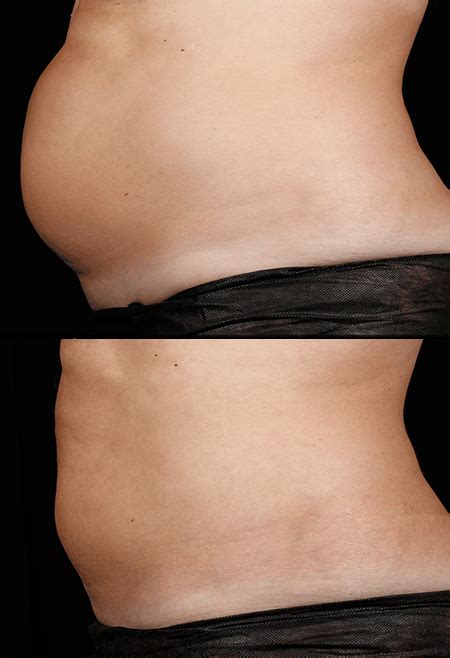 SculpSure Queensland : Laser Fat Removal & Reduction Specialists ...