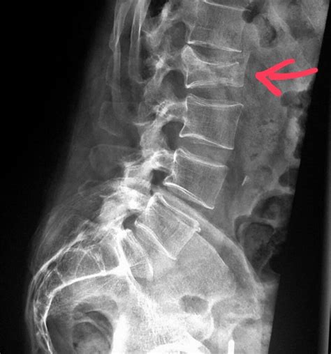 Compression Fracture X Ray - mapasgmaes