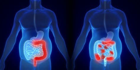 Ulcerative Colitis vs Crohn’s Disease | Alabama Colon & Rectal Institute