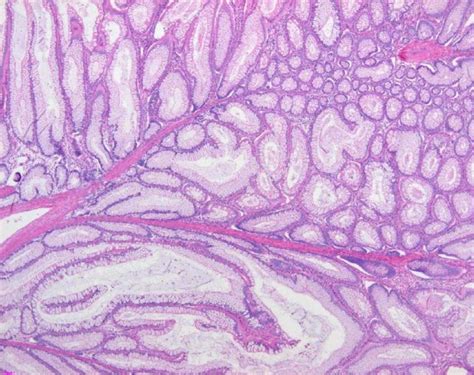 Adenomatous Polyp Histology