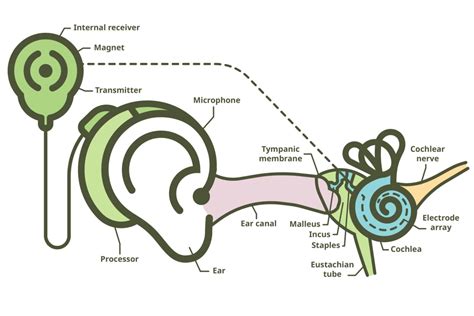 Cochlear Implants Pros And Cons (Everything You Must Know)