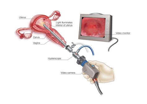 What is a Hysteroscopy? - Ruach