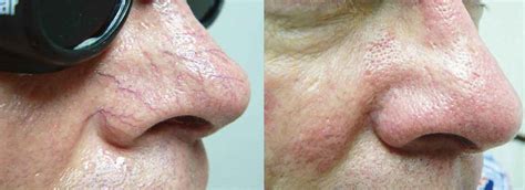 Spider Vein Before and After - Body Beautiful Laser Medi-spa