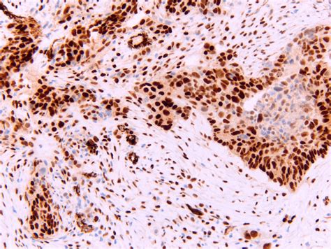 Sarcomatoid Carcinoma Lung Pathology