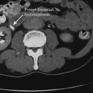 (PDF) Robotic Ureterolysis, Retroperitoneal Biopsy, and Omental Wrap for the Treatment of ...