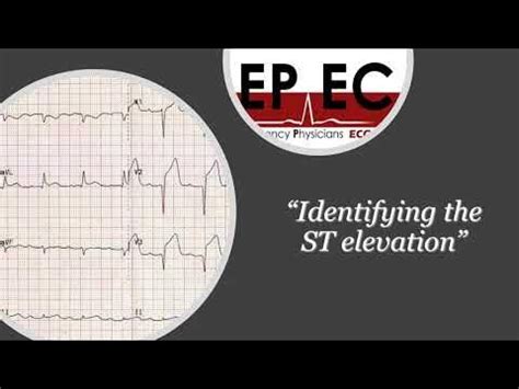 ECG Tip 1. Where is the isoelectric line? - YouTube