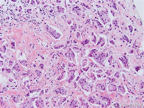 Typical Carcinoid Tumor of Lung