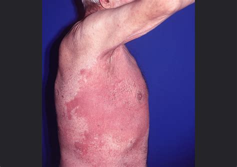 Update on Efficacy of Treatments for Cutaneous Candidiasis - Dermatology Advisor