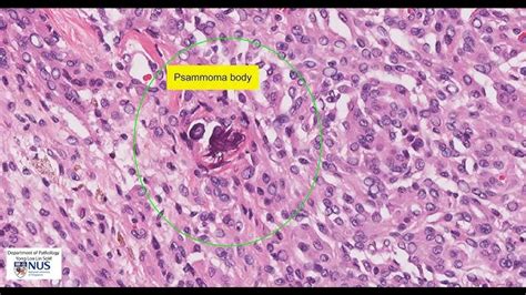 Craniopharyngioma Histology