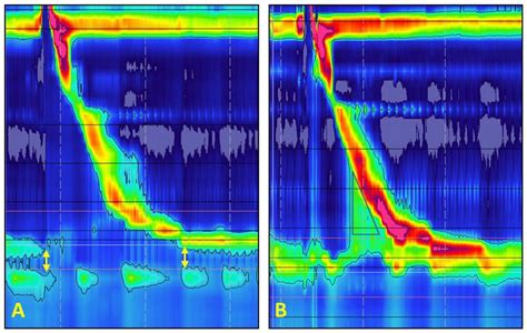 Diffuse Esophageal Spasm Manometry