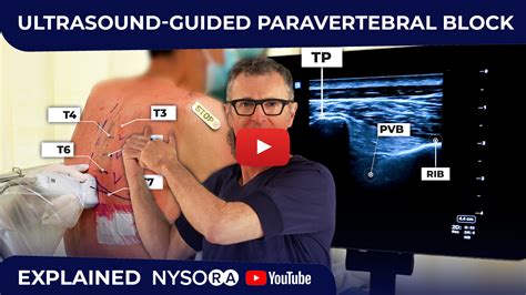 Paravertebral Block Ultrasound