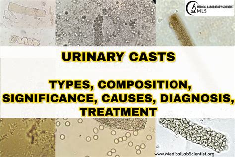 URINARY CASTS: Types, Composition, Significance, Causes, Diagnosis ...