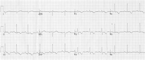 Arrhythmogenic Right Ventricular Cardiomyopathy Ecg | Images and Photos ...