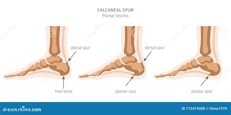 Calcaneal Spur. Plantar Fasciitis Set Stock Vector - Illustration of ...