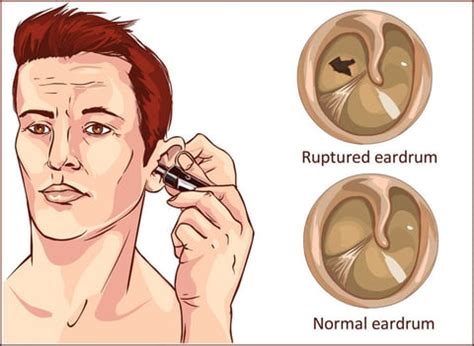 Tympanic Membrane Perforation: Symptoms, Causes, and Treatment Options