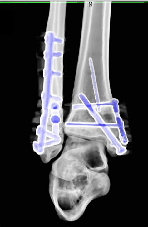 Tibial Plateau Fracture Orif