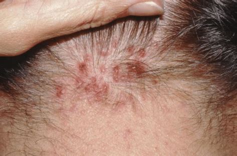 Pimples on Scalp, Painful, on Head that Hurt, Won’t Go Away, Acne, Causes, Treatment,Remedies ...