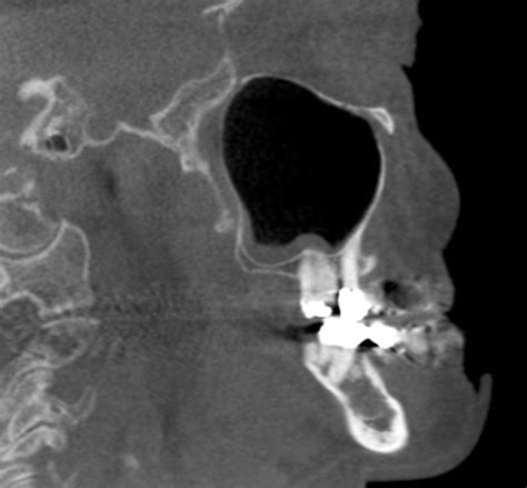 maxillary sinuses – Dr. G's Toothpix