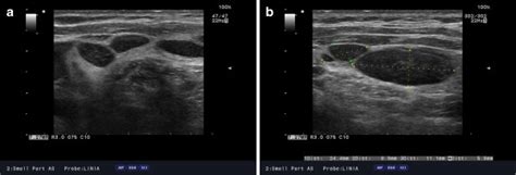 Swollen Lymph Nodes In Neck Ultrasound