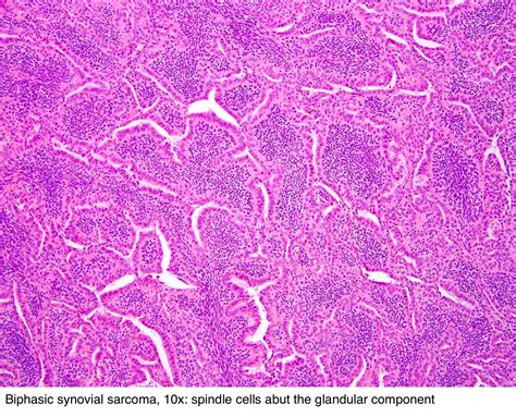 Pathology Outlines - Synovial sarcoma