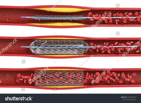 3 มิติการแสดงผลขั้นตอนการทำ angioplasty บอลลูนที่มีขดลวดในหลอดเลือดดำ ...