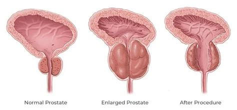 Transurethral Resection Of The Prostate