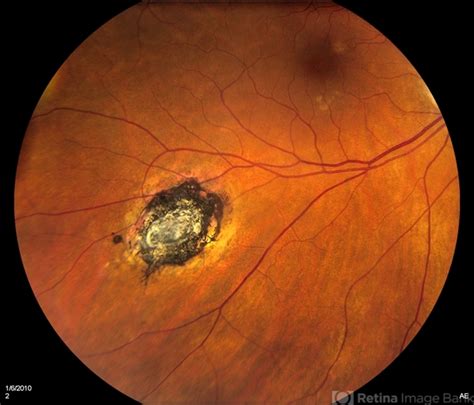 Disciform Scar - Retina Image Bank