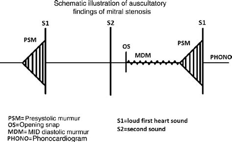 [PDF] Mitral Stenosis: A Review | Semantic Scholar