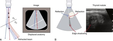 Ultrasound Artifacts | Radiology Key