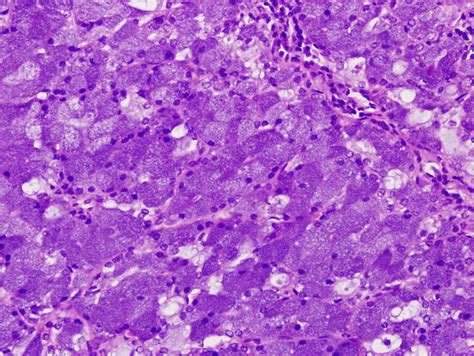 Pathology Outlines - Acinic cell carcinoma