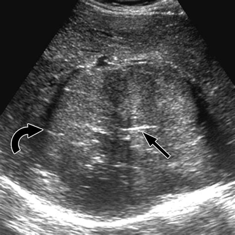 Hepatocellular Carcinoma Ultrasound