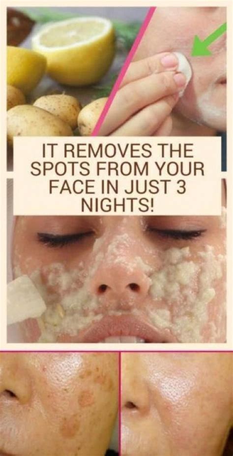 How to get Rid Of Brown Spots on Deal with #BrownSpotsOnFaceTreatment # ...