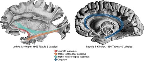 Uncinate Fasciculus Anatomy