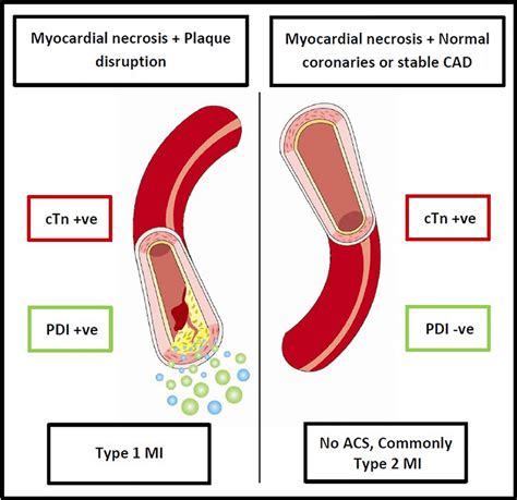 Hypothesized role of the PDI in distinguishing type 1 and type 2 ...