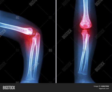 Rheumatoid Arthritis Image & Photo (Free Trial) | Bigstock