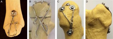 Examples of figure-of-8 tension band wire constructs are shown here.... | Download Scientific ...