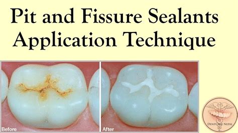 Pit And Fissure Sealants