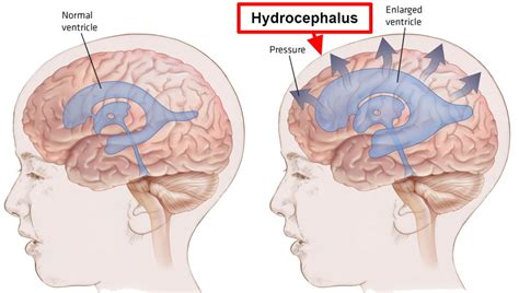 Hydrocephalus - Causes, Symptoms In Babies & Adults, Treatment