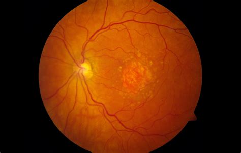 Geographic Atrophy Risk-Associated Biomarkers Identified in Intermediate AMD - Ophthalmology Advisor