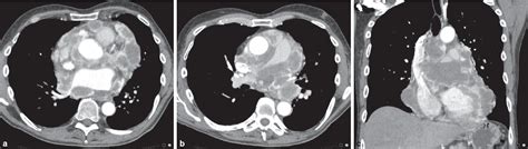 Primary pericardial mesothelioma presenting as multiple pericardial masses on CT | Semantic Scholar