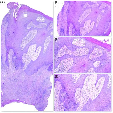 (PDF) Acitretin may improve symptoms and exudation in patients affected by elephantiasis nostras ...