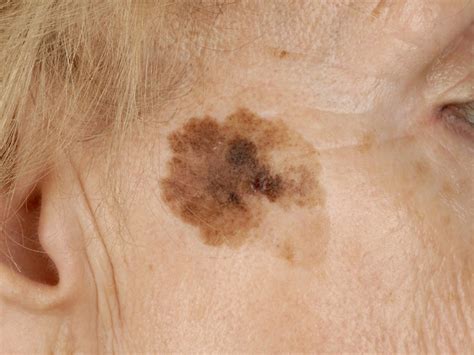 lentigo melanoma - pictures, photos