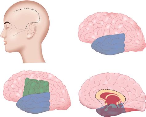 Schematic demonstration of the functional hemispherectomy technique ...