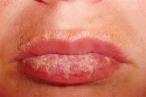 Dry Patches on Lip, Upper, Lower, Pictures, Causes, Not Cold Sore ...