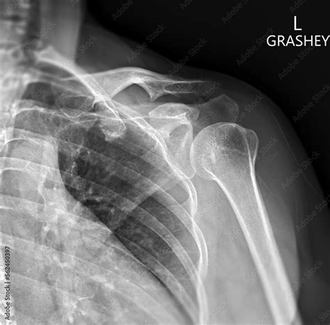 X-ray of Shoulder joint Grashey view for diagnosis shoulder joint from dislocation or fracture ...