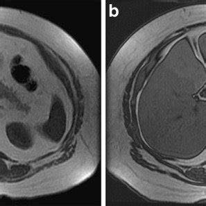 a–c Severe geographic fatty liver deposition. MRI of the liver in a... | Download Scientific Diagram