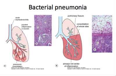 What Should You Know About Bacterial Pneumonia? - (July 2024)