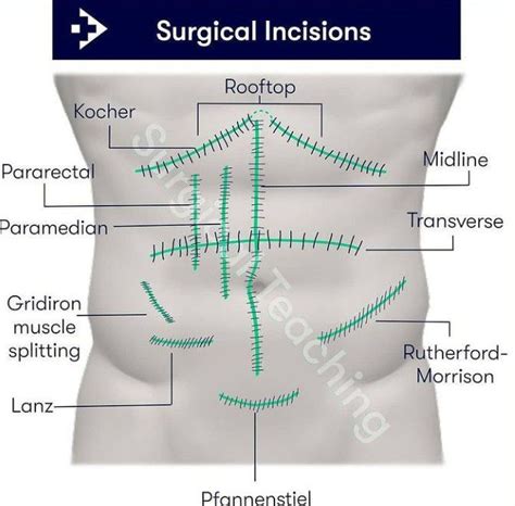 Abdominal Surgical Incisions